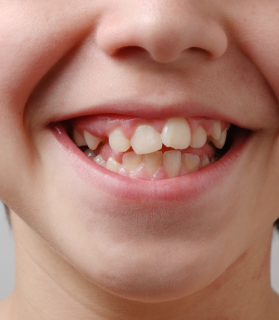Before orthodontic treatment