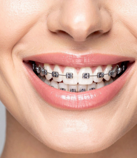 After orthodontic treatment