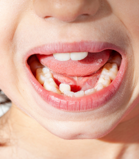 Before kids orthodontic treatment
