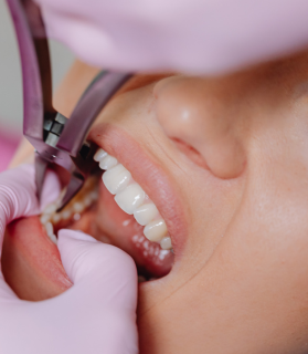 Before adult alignment treatment
